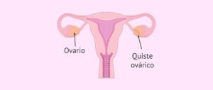 Quistes ováricos destacada