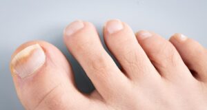 eliminar los hongos de las uñas destacadaa